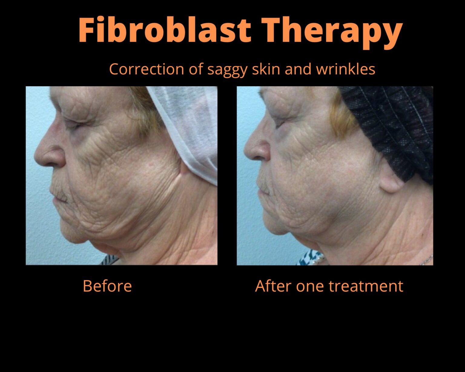 Before and After Image of Fibroblast Therapy Leesburg FL