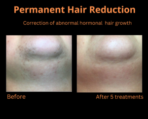 Before and After Image of Permanent Hair Reduction Leesburg