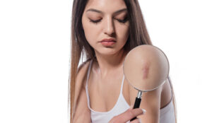 Woman holding magnifying glass to scar on her arm from Mohs surgery in Leesburg, FL
