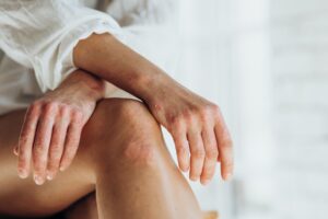 Close up of woman's hands and legs with psoriasis outbreak in Leesburg, FL
