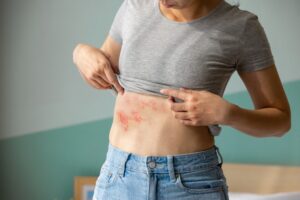 Woman lifting her shirt to show rash on stomach from hidden skin allergies in Leesburg, FL